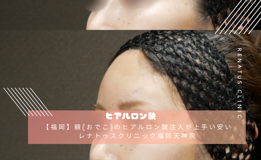 【福岡】額(おでこ)のヒアルロン酸注入が上手い安いレナトゥスクリニック