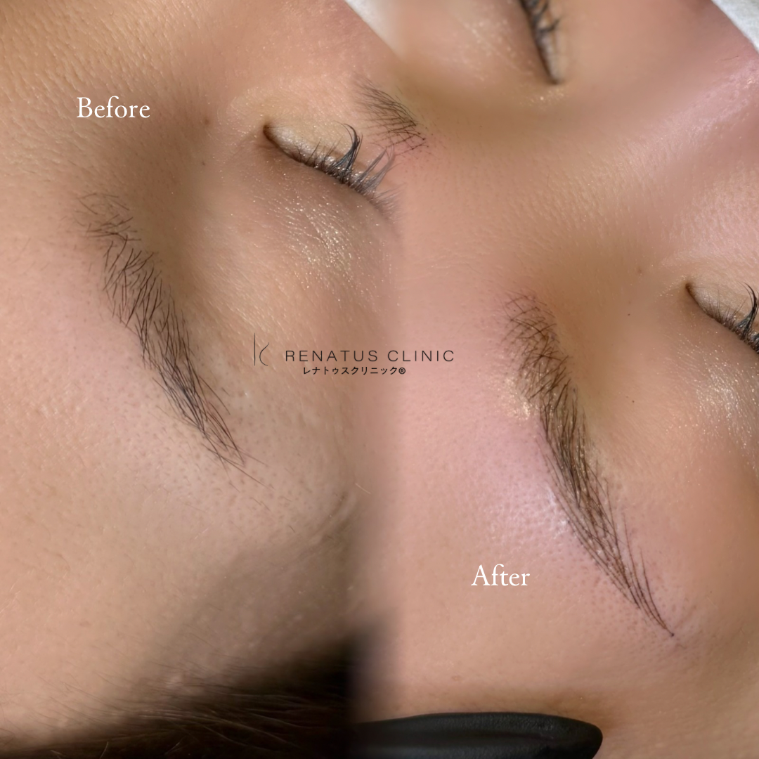 医療アートメイク専門レナトゥスクリニック 5 東京でおすすめの眉アートメイク