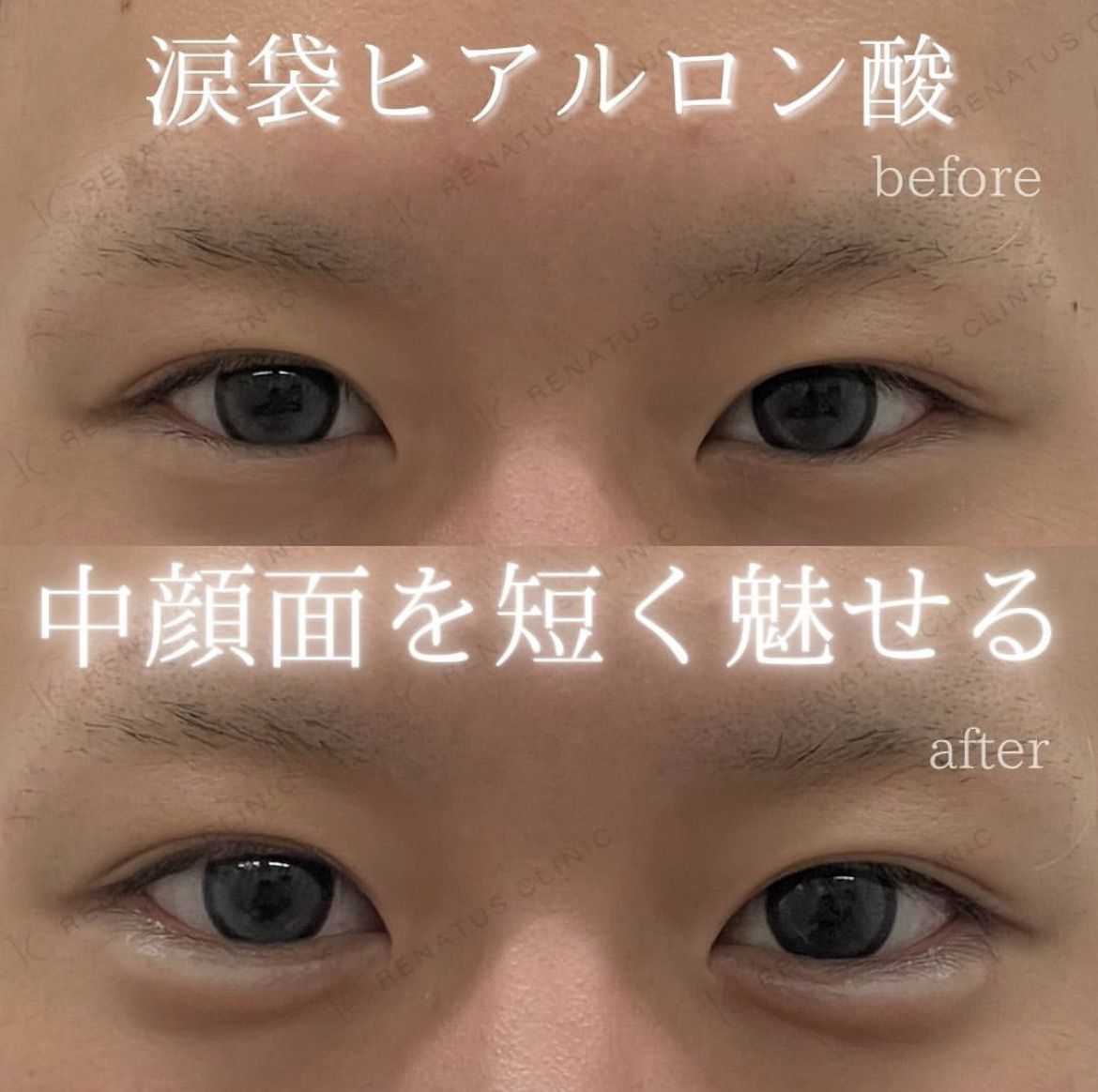 メンズ涙袋整形ヒアルロン酸でイケメンの作り方 7 メンズ涙袋ヒアルロン酸