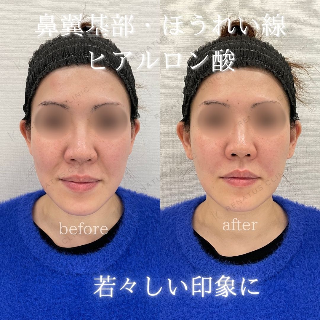 鼻翼基部ヒアルロン酸貴族フィラー仙台名医