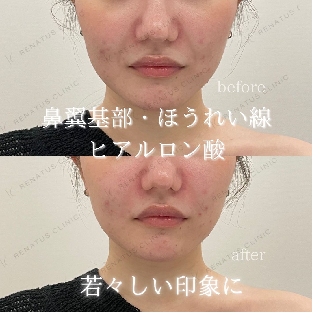 鼻翼基部ヒアルロン酸貴族フィラー仙台名医