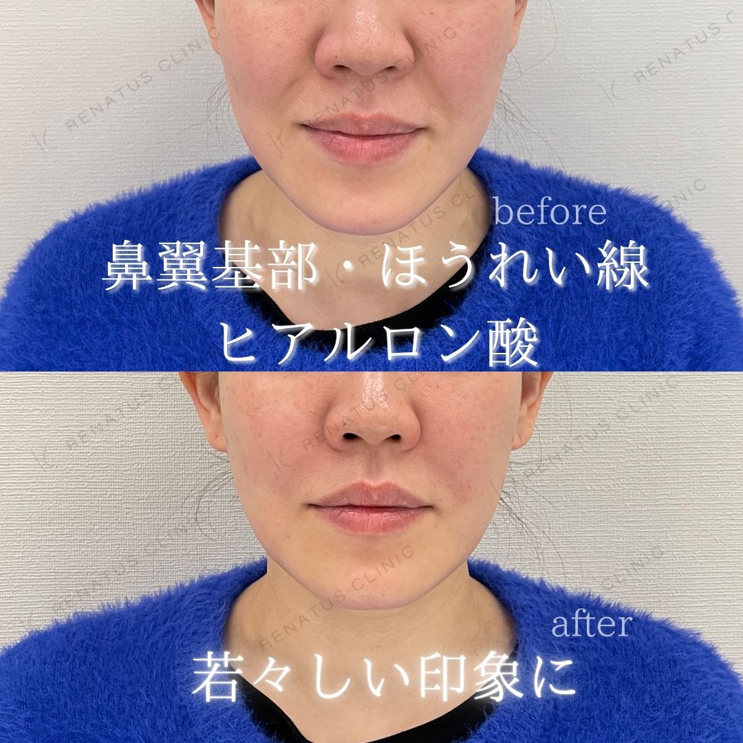 仙台の鼻翼基部ヒアルロン酸貴族フィラー名医ならレナトゥスクリニック仙台院 8 鼻翼基部ヒアルロン酸貴族フィラー仙台名医