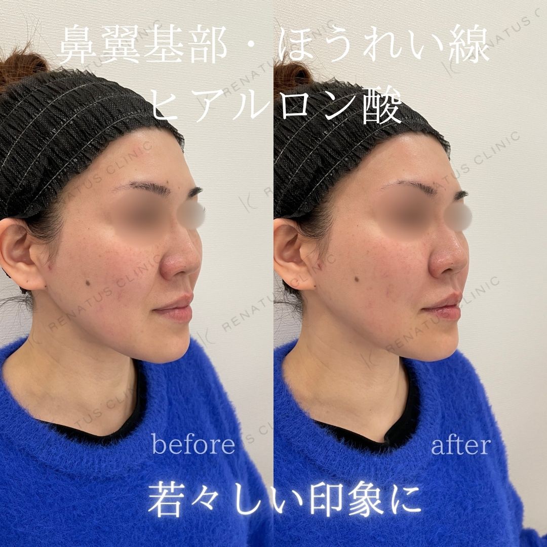鼻翼基部ヒアルロン酸貴族フィラー仙台名医
