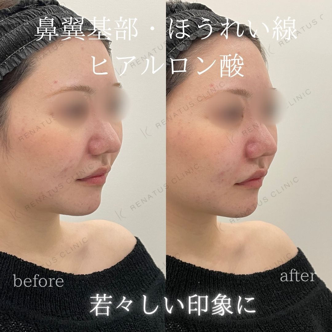 鼻翼基部ヒアルロン酸貴族フィラー仙台名医
