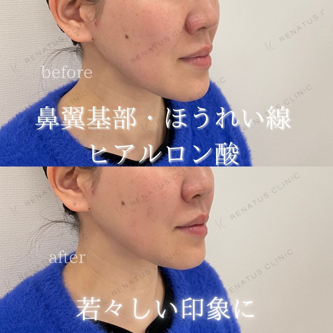 鼻翼基部ヒアルロン酸貴族フィラー仙台名医