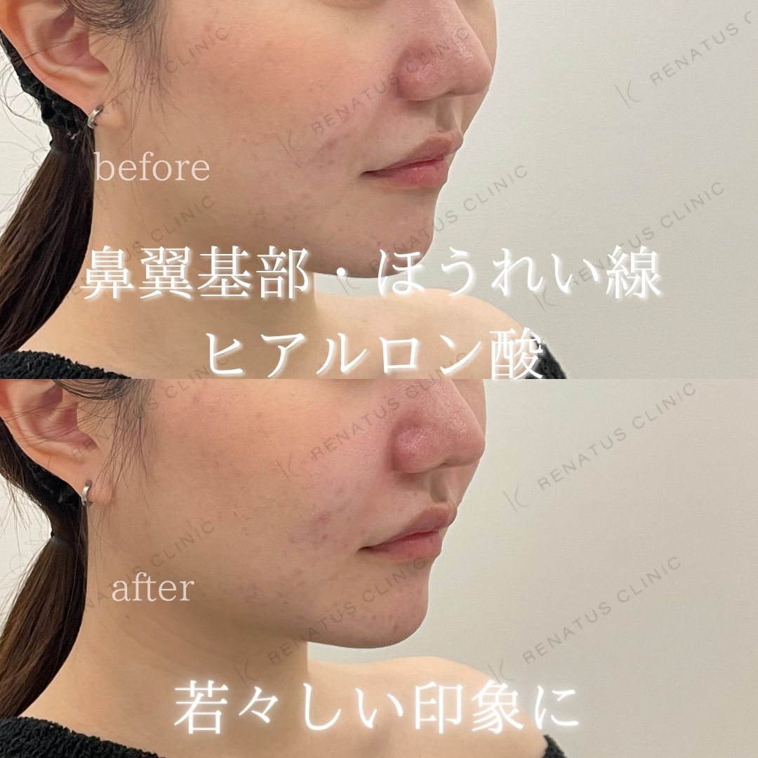 仙台の鼻翼基部ヒアルロン酸貴族フィラー名医ならレナトゥスクリニック仙台院 17 鼻翼基部ヒアルロン酸貴族フィラー仙台名医