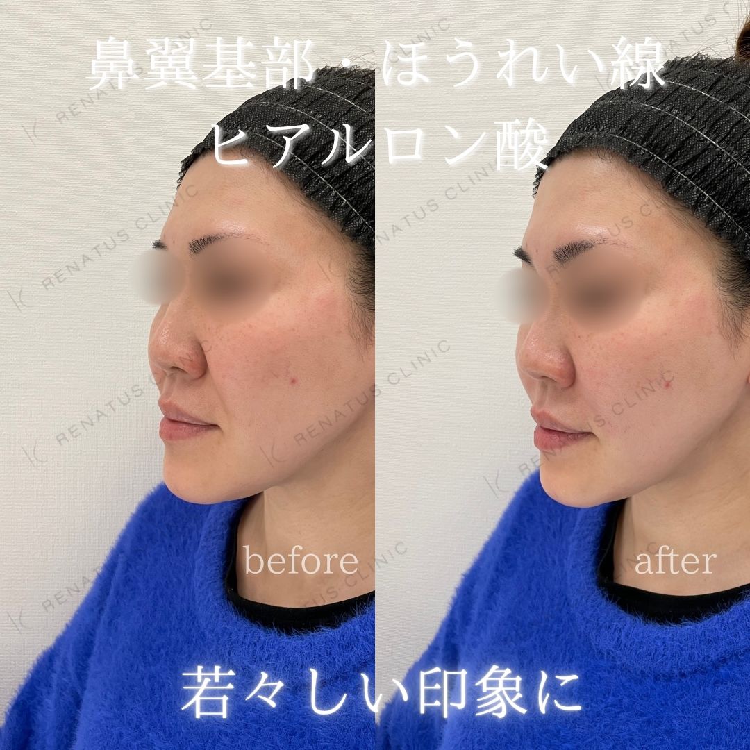 鼻翼基部ヒアルロン酸貴族フィラー仙台名医