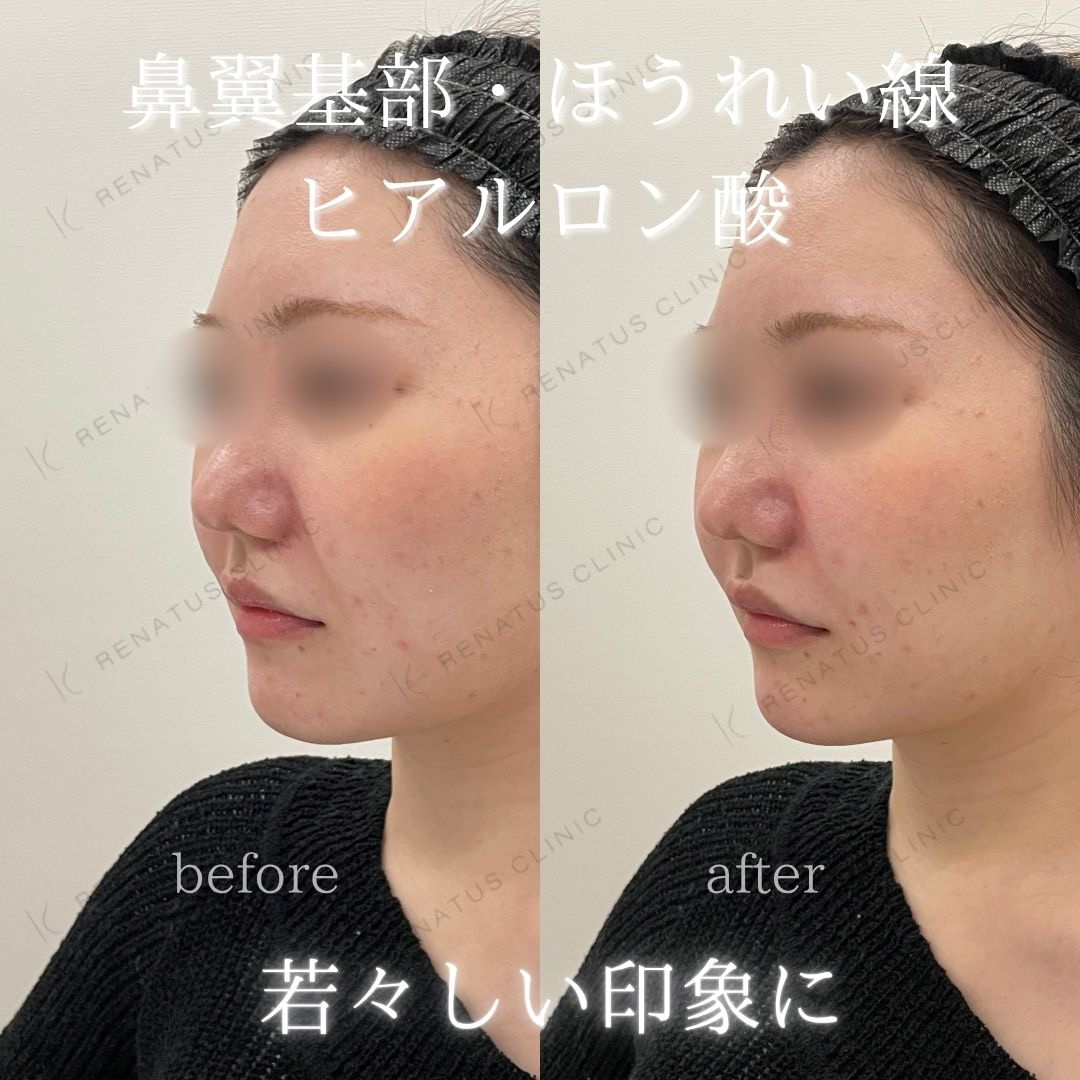 鼻翼基部ヒアルロン酸貴族フィラー仙台名医