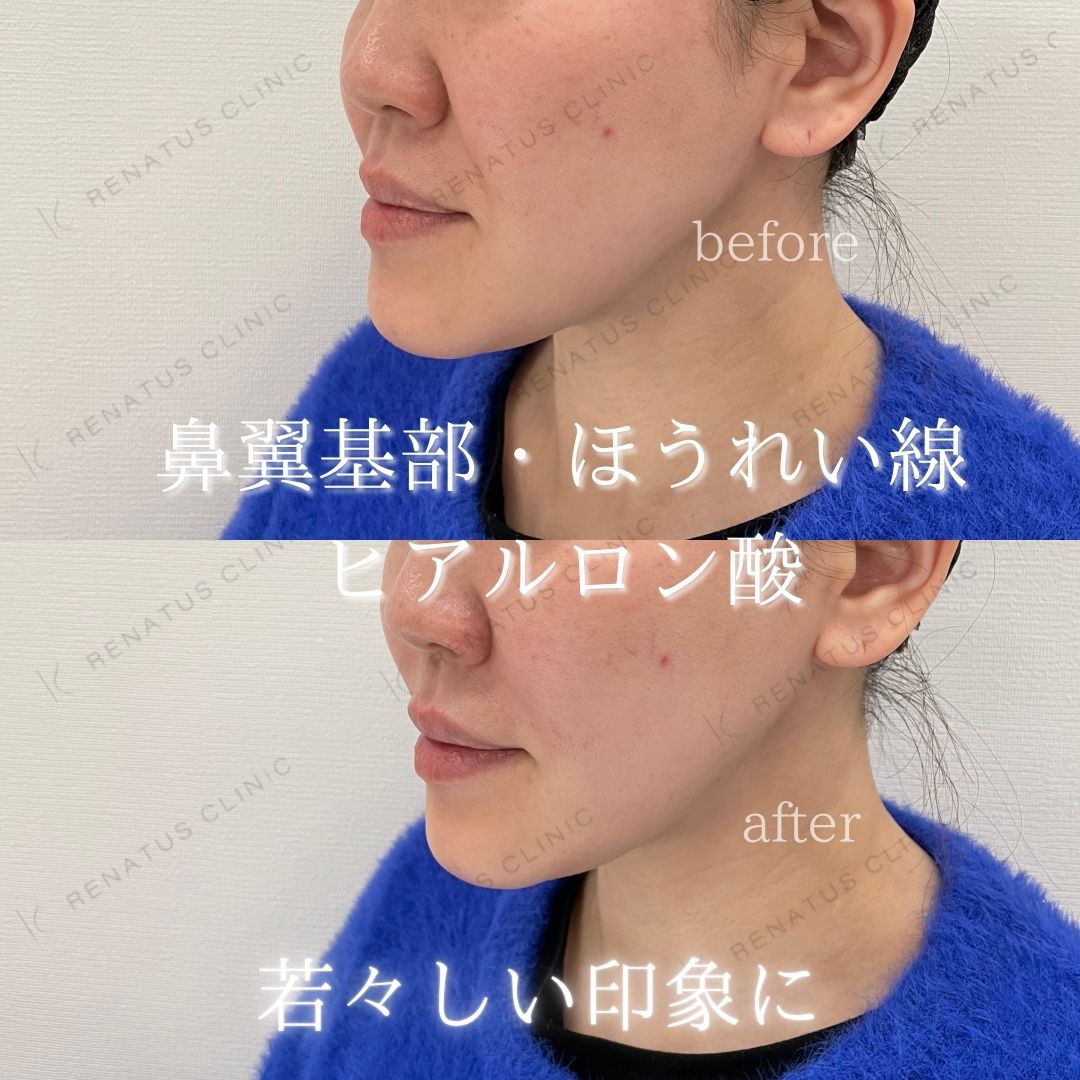 仙台の鼻翼基部ヒアルロン酸貴族フィラー名医ならレナトゥスクリニック仙台院 1 鼻翼基部ヒアルロン酸貴族フィラー仙台名医
