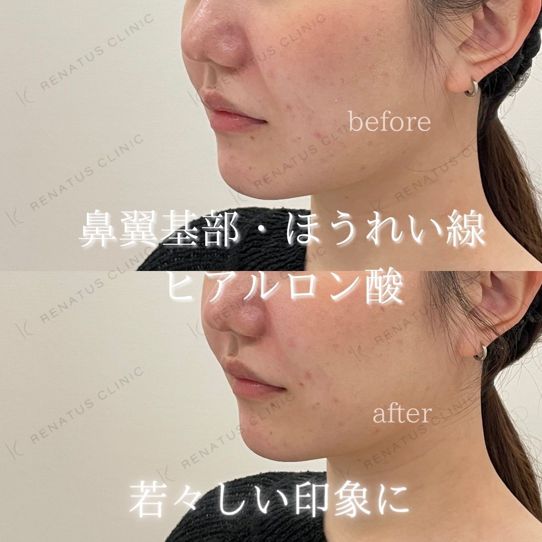 鼻翼基部ヒアルロン酸貴族フィラー仙台名医