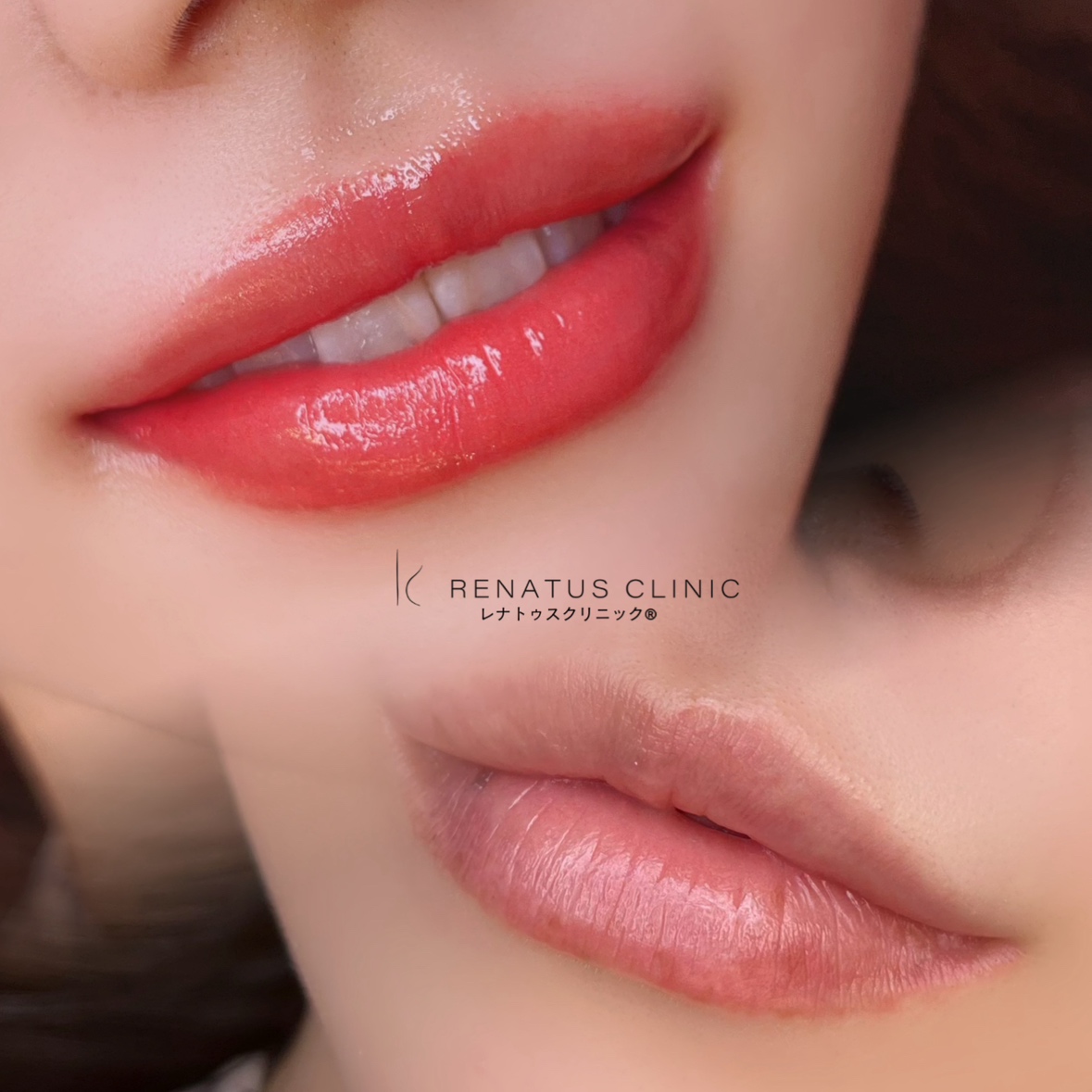 東京のアートメイク眉リップが上手い安い¥29,999おすすめならレナトゥスクリニック(メンズ可) 15 唇アートメイク東京上手い安い
