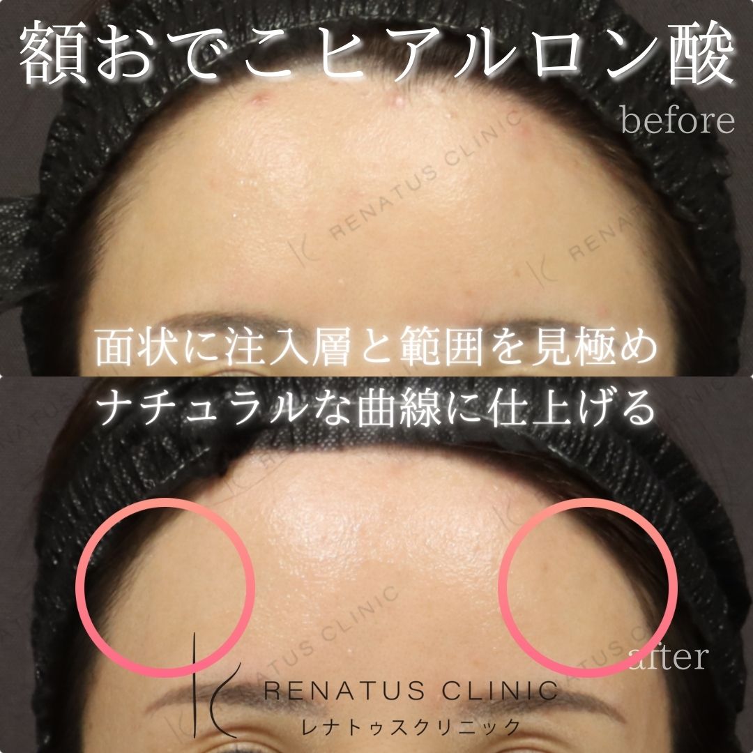 おでこヒアルロン酸減りやすい場所