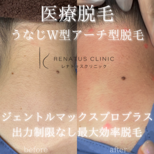 医療脱毛とは 11 うなじ髪の毛医療脱毛