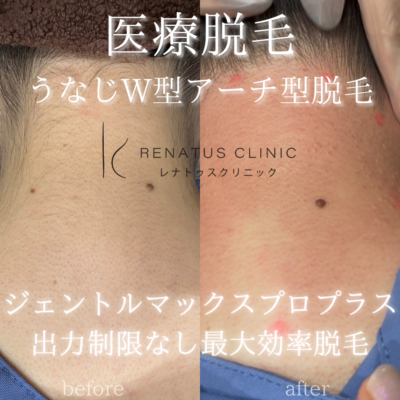 うなじ髪の毛医療脱毛 16 うなじデザイン医療脱毛
