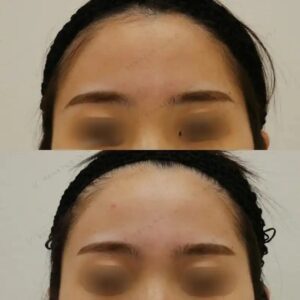 医療脱毛と光の吸収・発熱・SP理論とは? 5 額(おでこ)脱毛(髪の毛部分含む)