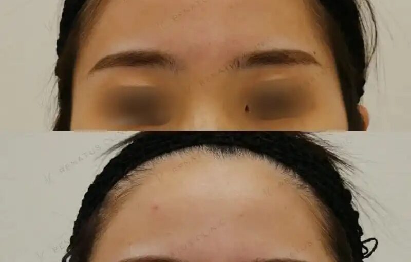 おでこ髪の毛部分医療脱毛１