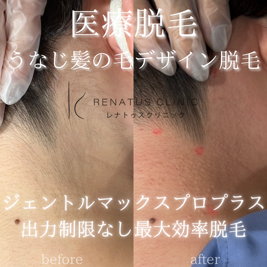 うなじデザイン医療脱毛
