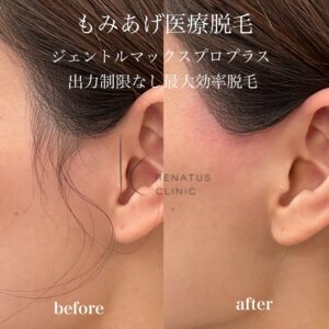 医療脱毛とは 12 もみあげ髪の毛医療脱毛