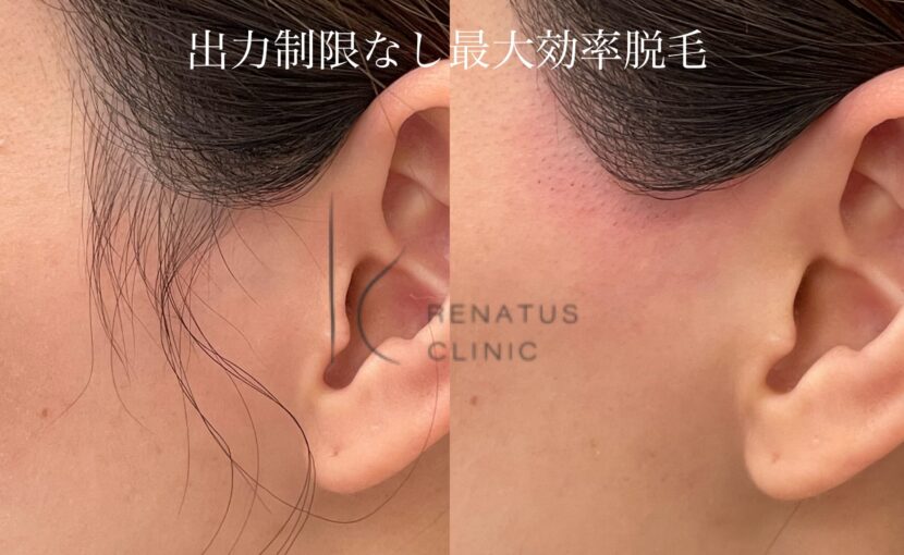 もみあげ髪の毛医療脱毛