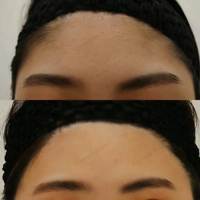 額(おでこ)脱毛(髪の毛部分含む) 8 おでこ髪の毛部分医療脱毛2