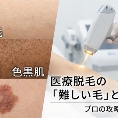 医療脱毛の「難しい毛」とその対策 白髪・産毛・色黒肌・アザ…プロの攻略法