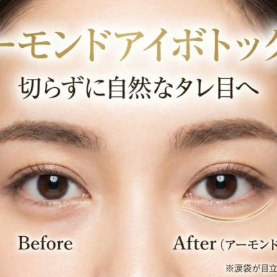 アーモンドアイボトックス(タレ目) 10 アーモンドアイボトックス(タレ目)