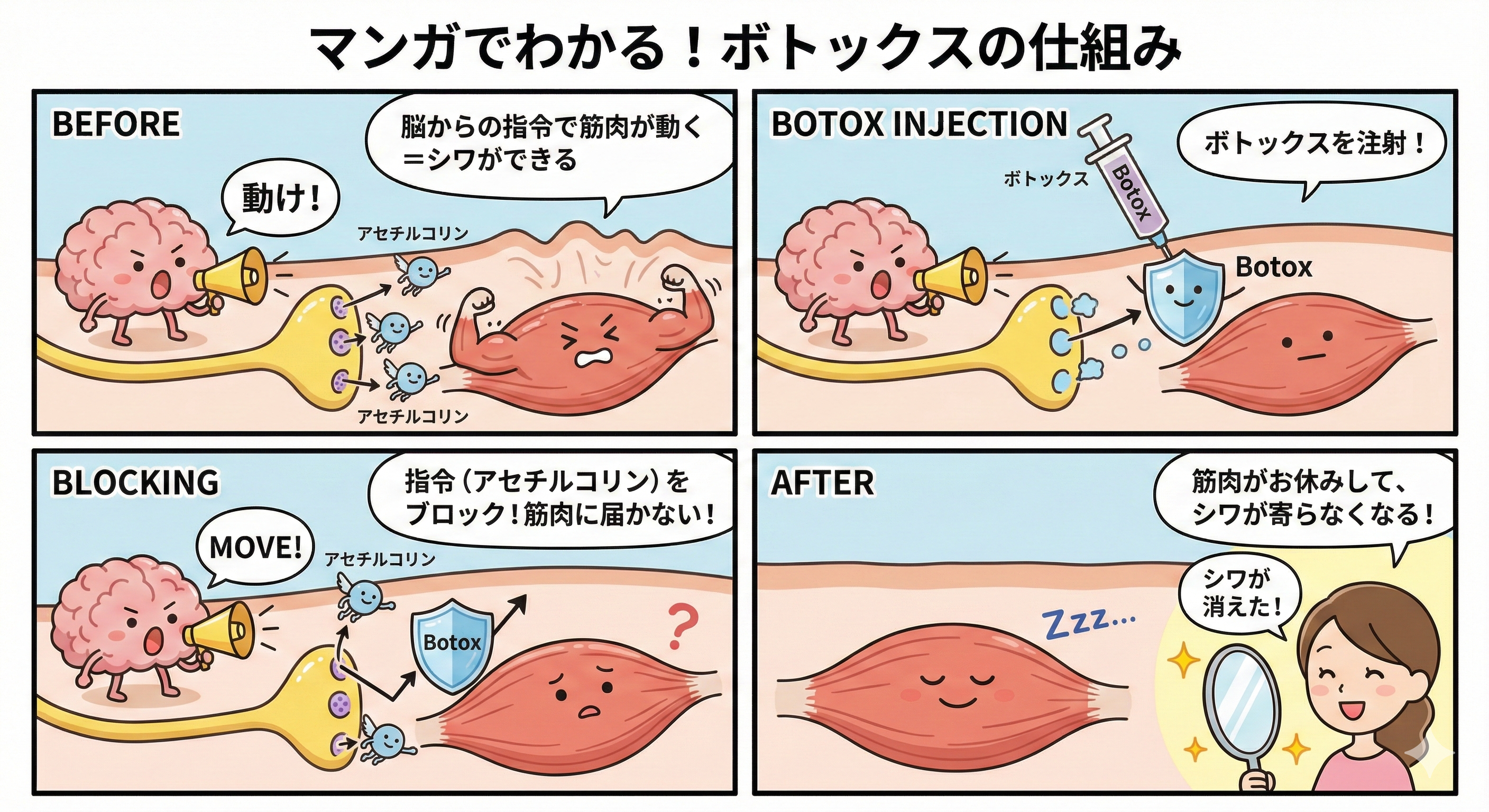 視覚的にわかるボトックスの作用機序4コマ漫画