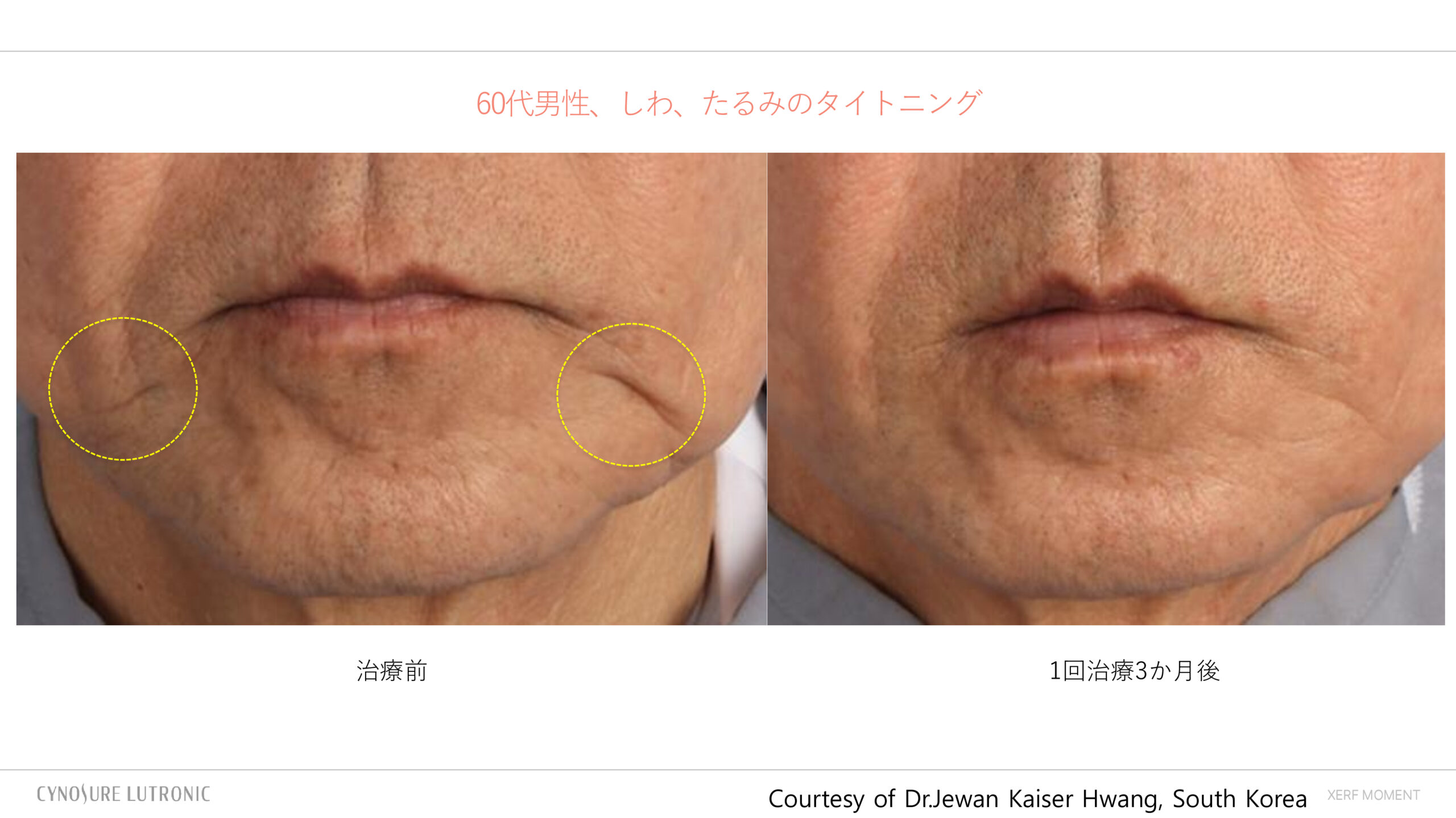 ザーフXERF奨励写真