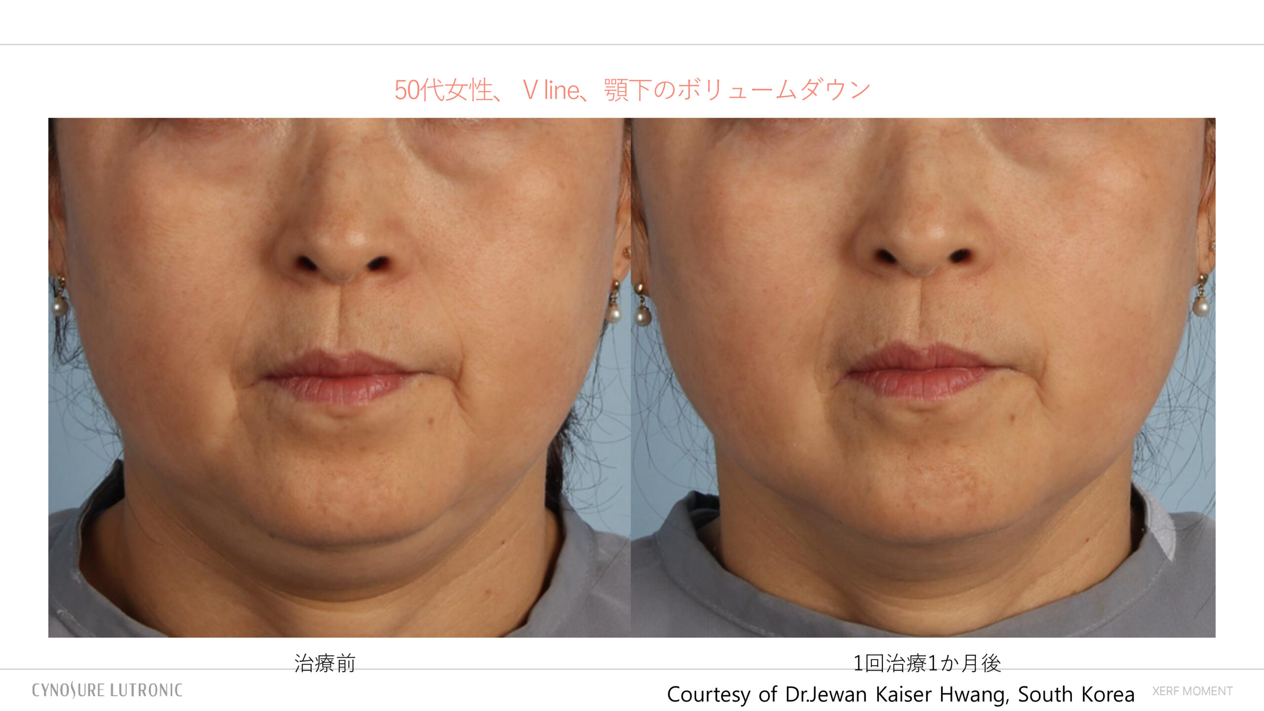 ザーフ(XERF)の痛みやダウンタイムはどれくらい?痛みを抑える照射のコツ 2 ザーフXERF奨励写真