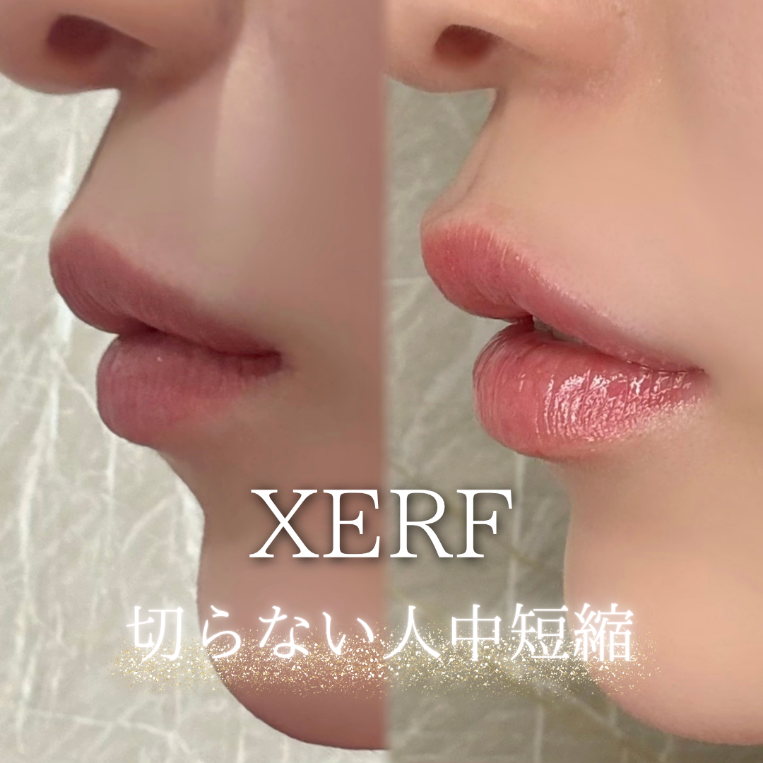 ザーフXERF 8 ザーフによる人中短縮 横顔