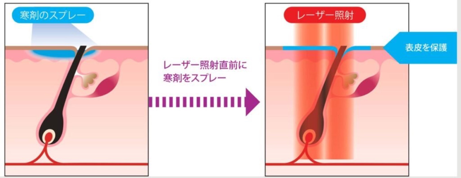 冷却スプレー（DCD）でレーザー照射直前に表皮を保護する仕組みの図