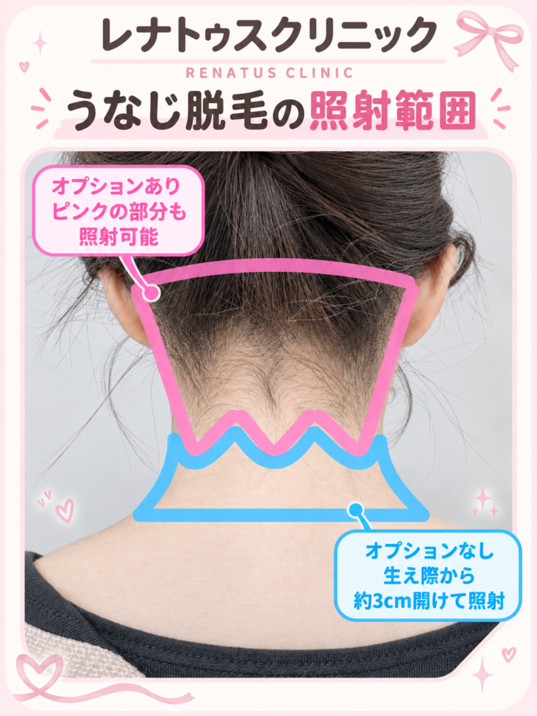 襟足とは?医療脱毛のうなじ襟足の範囲はどこまで?髪の毛は含まれる? 1 レナトゥスクリニックのうなじ脱毛の照射範囲(オプションなし・髪の毛部分オプションあり)