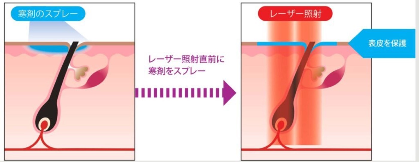 富山での医療VIO脱毛|ジェントルマックスプロプラス・VIOのみの値段・何回でツルツル?都度払い・痛み 17 ジェントルマックスプロプラスの冷却ガス(DCD)の仕組み