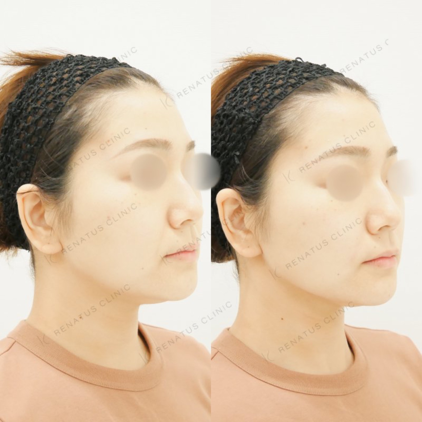 20代女性・仙台院のほうれい線ヒアルロン酸症例：ボリフト2ccの注入直前と直後（右斜め）