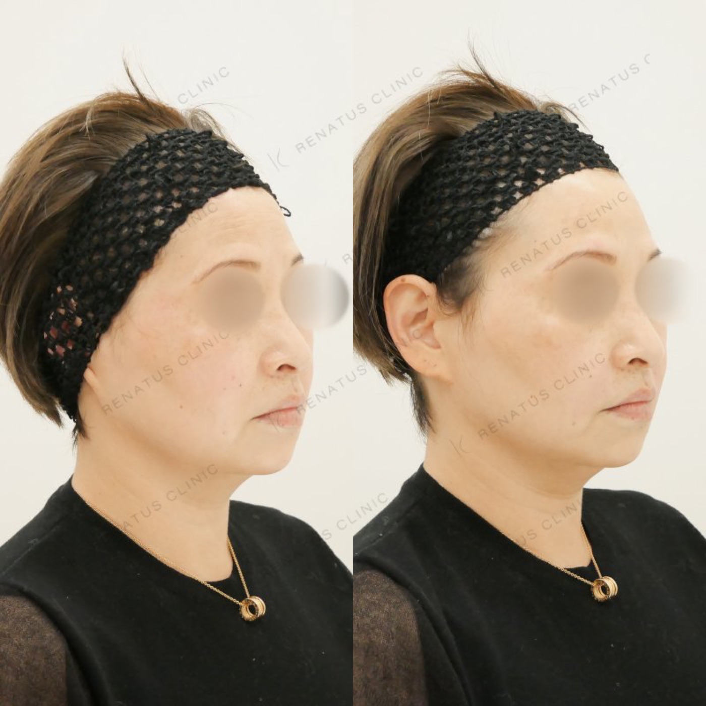 50代女性・仙台院のほうれい線ヒアルロン酸症例：ボリフト2ccの注入直前と直後（右斜め）