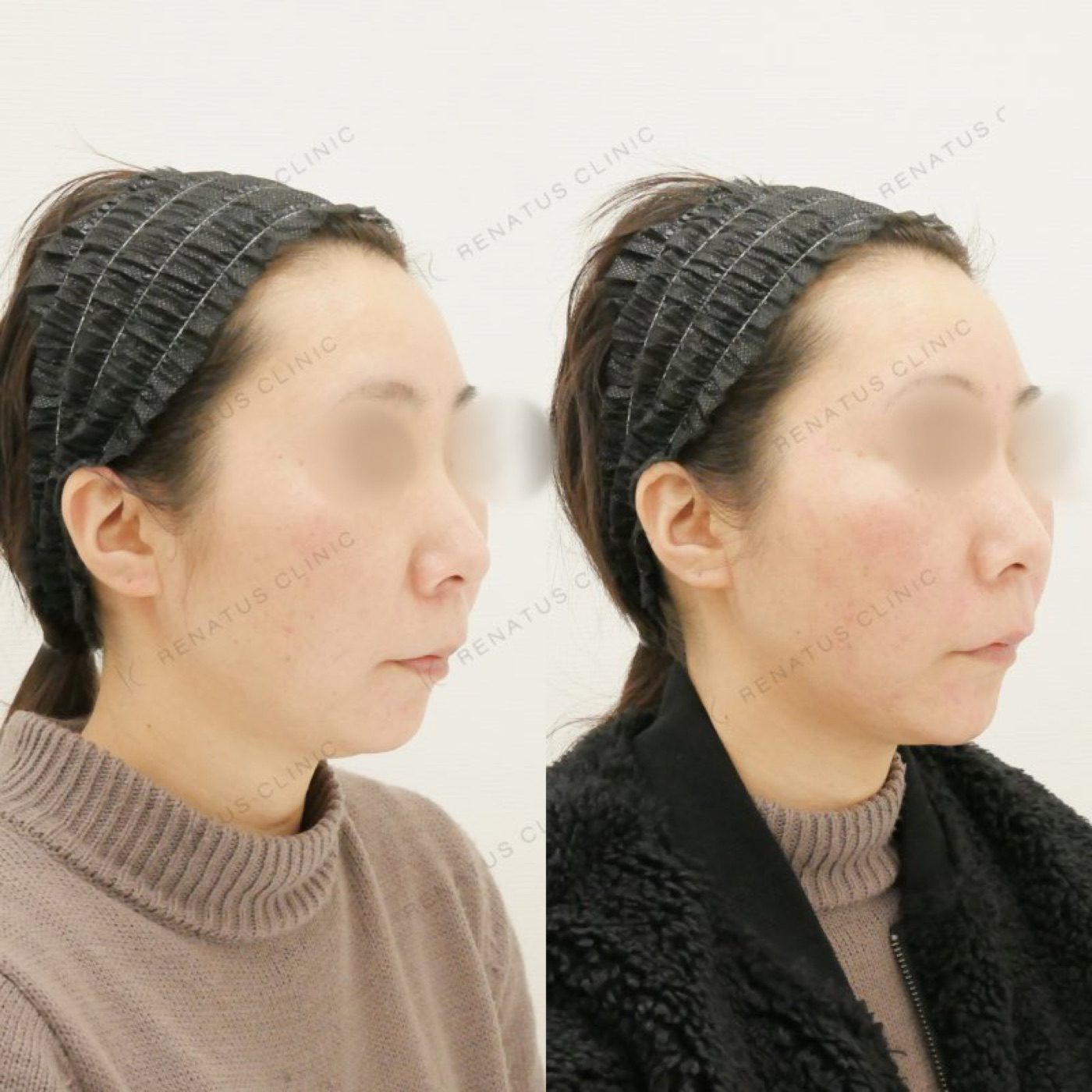 顎ヒアルロン酸(顎 ヒアルロン酸)の費用・何cc・持ち【公式】 10 40代女性・仙台院の顎ヒアルロン酸症例:ボラックス1ccの注入直前と直後