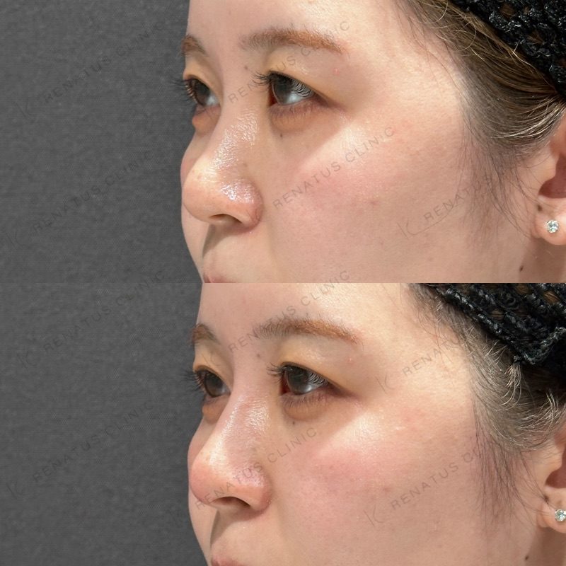 鼻ヒアルロン酸 デメリット|太くなる、バレるリスクと失敗しない方法も紹介 17 鼻ヒアルロン酸の症例(ボラックス・30代女性)。注入前と注入後の比較