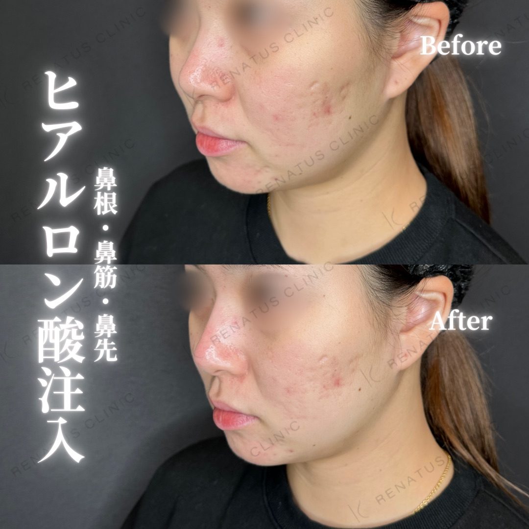 鼻ヒアルロン酸 デメリット|太くなる、バレるリスクと失敗しない方法も紹介 12 鼻ヒアルロン酸の症例(ボラックス・20代女性)。注入前と注入後の比較