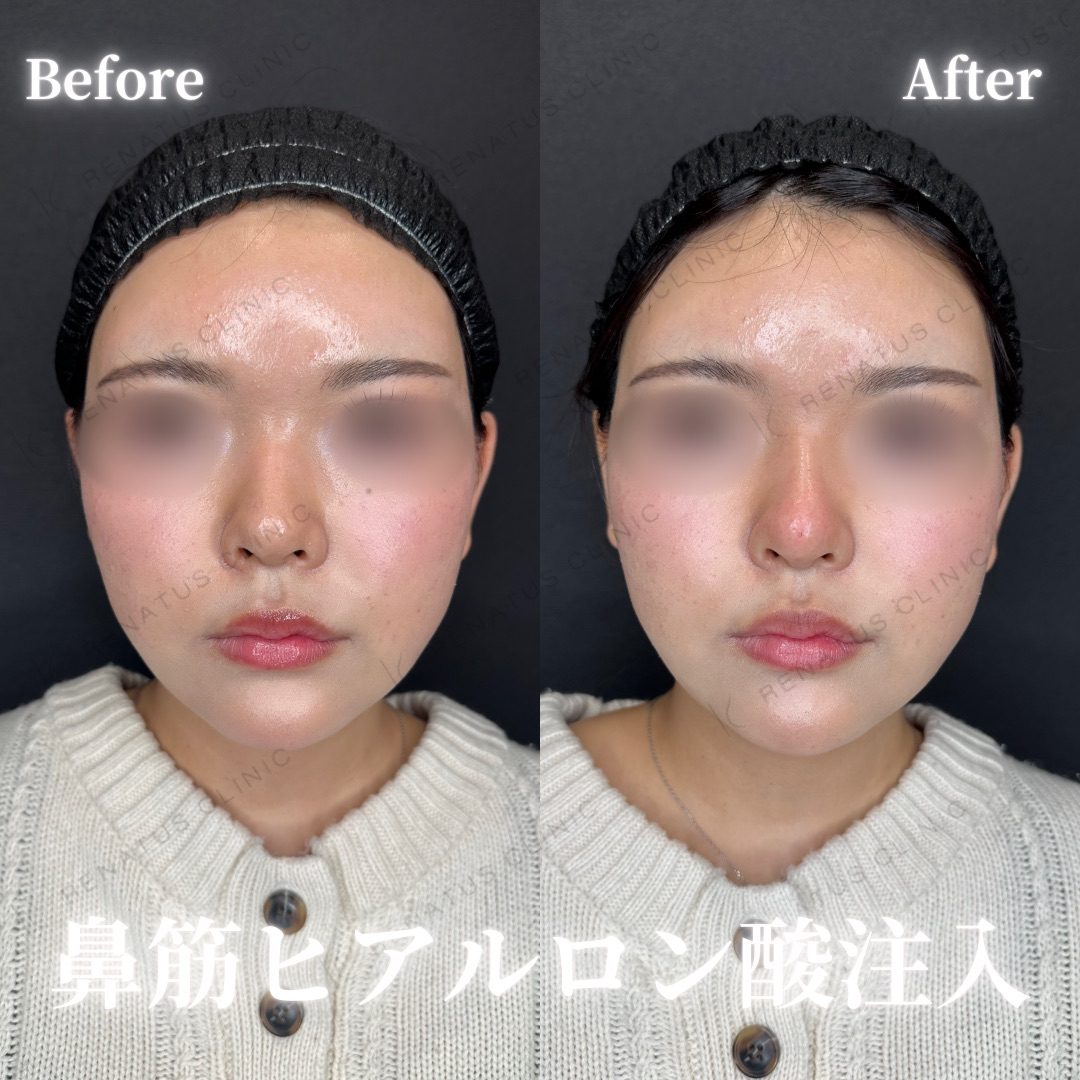 鼻ヒアルロン酸 デメリット|太くなる、バレるリスクと失敗しない方法も紹介 10 鼻ヒアルロン酸の症例(ボラックス・20代女性)。注入前と注入後の比較