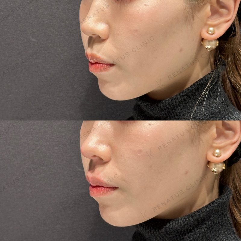 鼻ヒアルロン酸の症例（ボラックス・20代女性）。注入前と注入後の比較