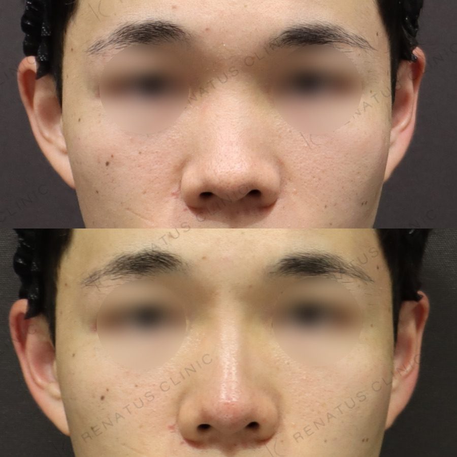 鼻ヒアルロン酸の症例（ボラックス・20代男性）。注入前と注入後の比較