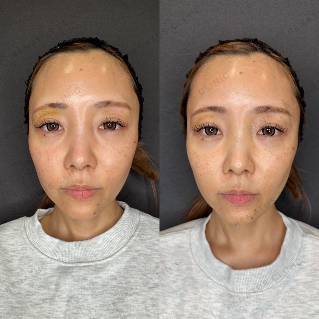 目の上（目のくぼみ）ヒアルロン酸の症例（ボルベラ・40代女性）。注入前と注入後の比較