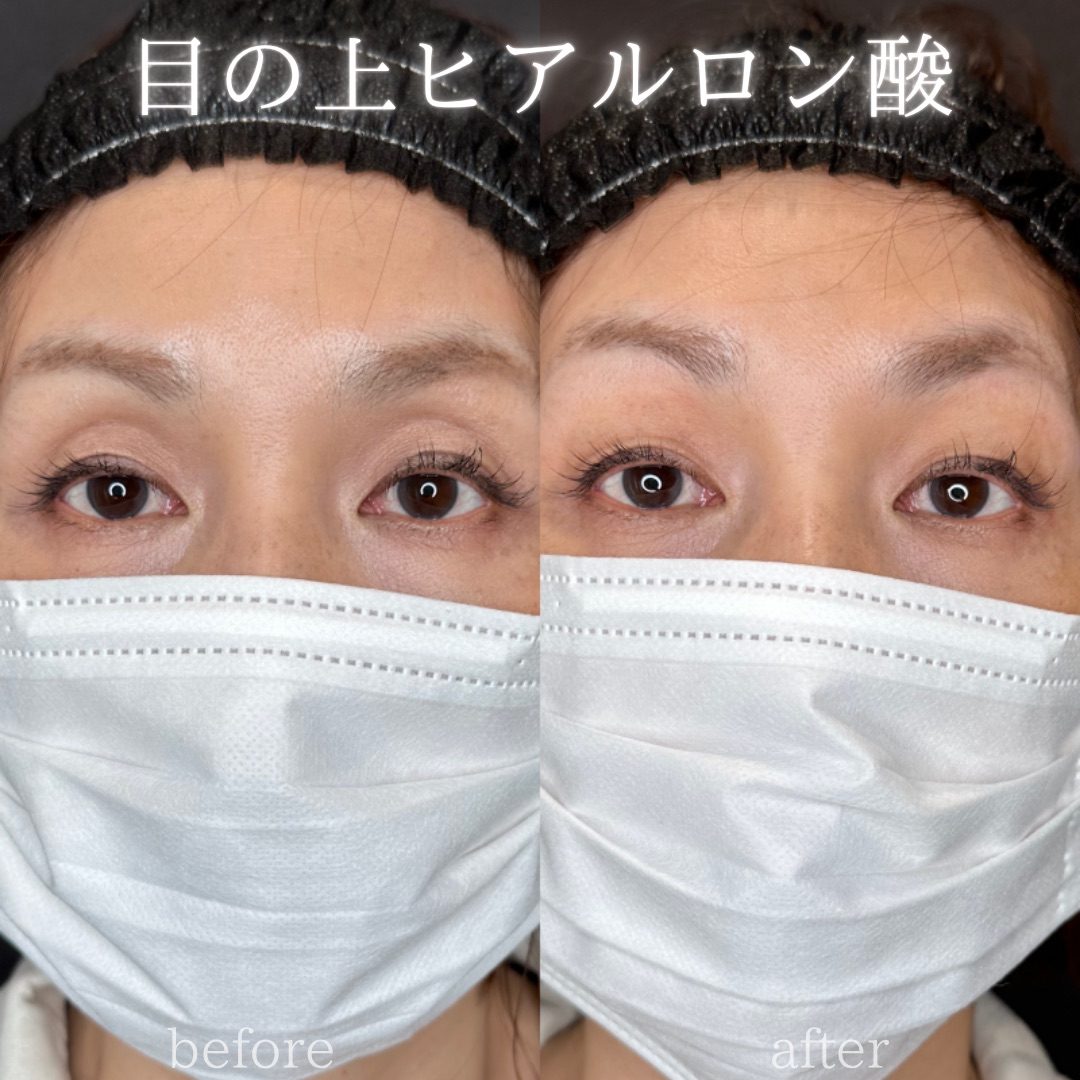 目の上（目のくぼみ）ヒアルロン酸の症例（ボルベラ・50代女性）。注入前と注入後の比較