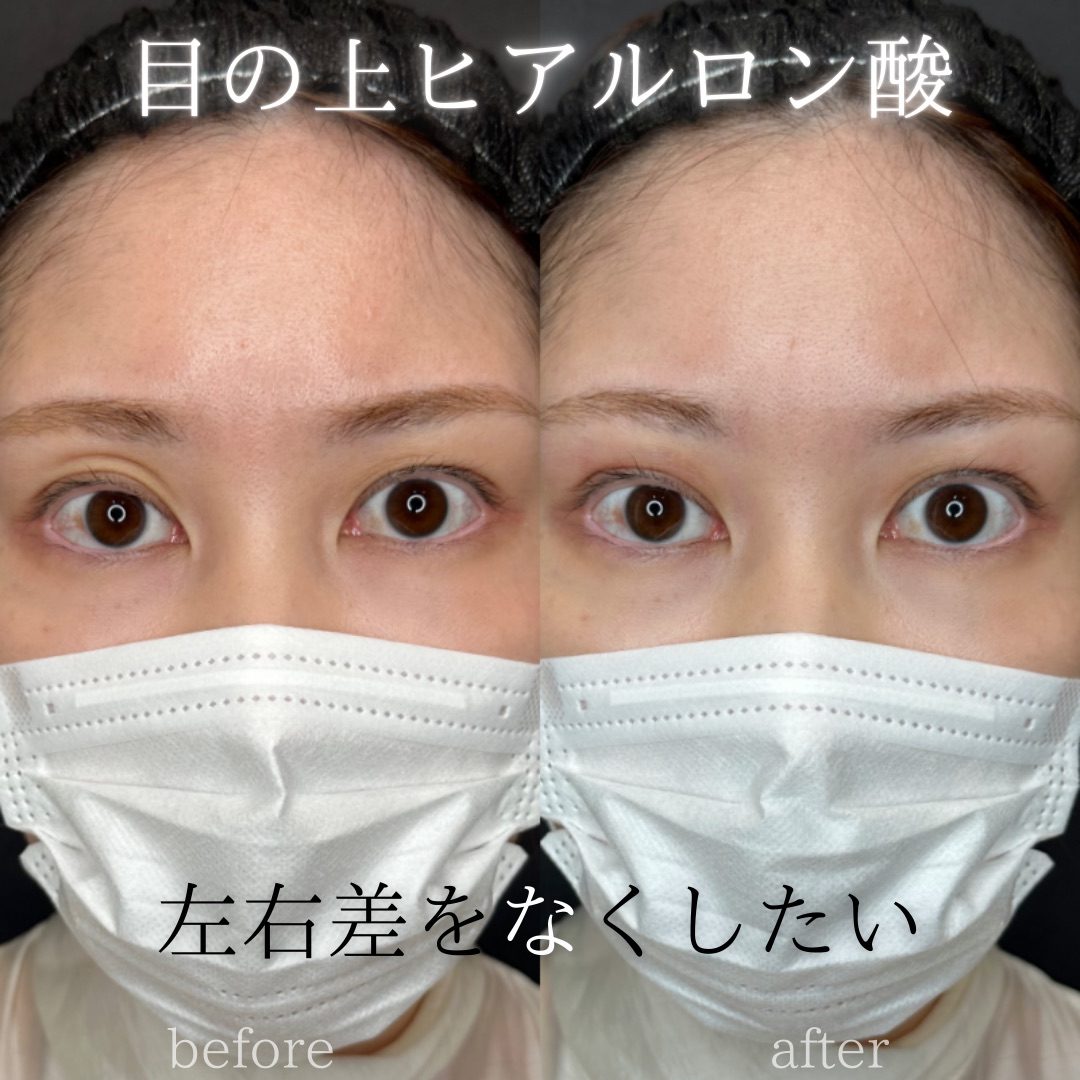 目の上（目のくぼみ）ヒアルロン酸の症例（ボルベラ・30代女性）。注入前と注入後の比較