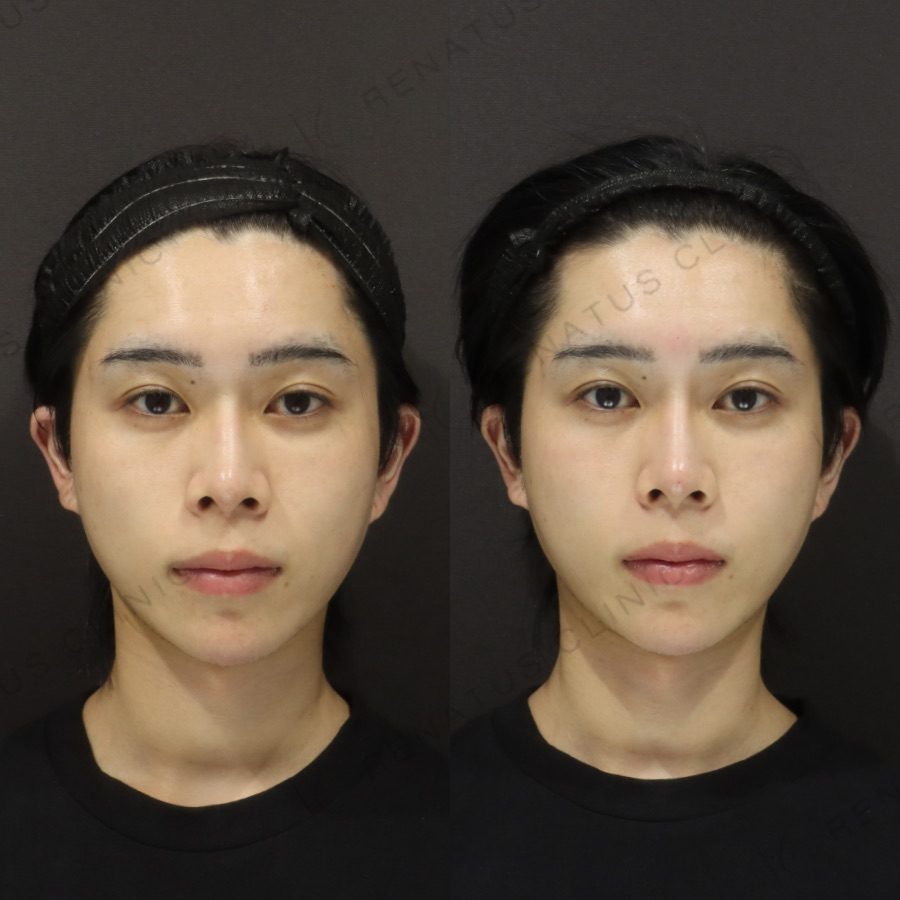 鼻ヒアルロン酸の症例（ボラックス・20代男性）。注入前と注入後の比較