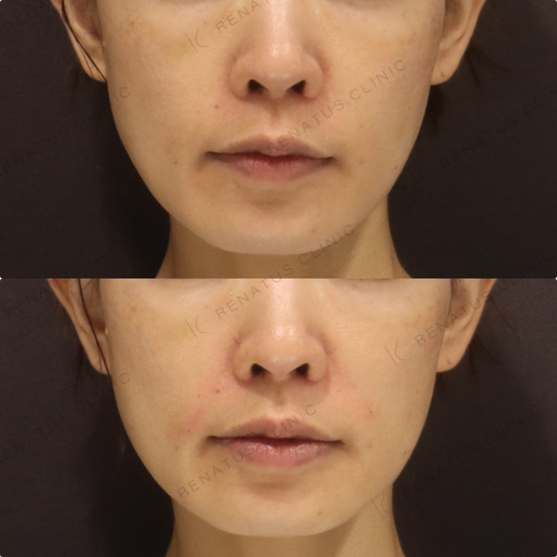 ためしてガッテンのほうれい線の消し方は効く?顔のたるみ改善を美容皮膚科医が解説 38 ほうれい線ヒアルロン酸の症例(ボリフト・40代女性)。注入前と注入後の比較