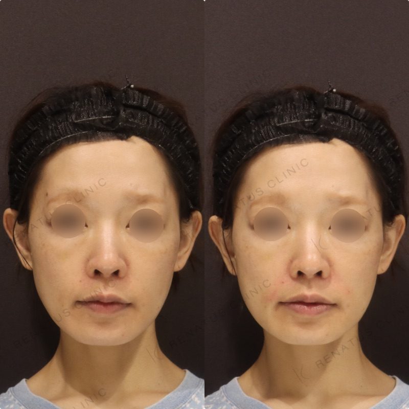 ためしてガッテンのほうれい線の消し方は効く?顔のたるみ改善を美容皮膚科医が解説 37 ほうれい線ヒアルロン酸の症例(ボリフト・40代女性)。注入前と注入後の比較