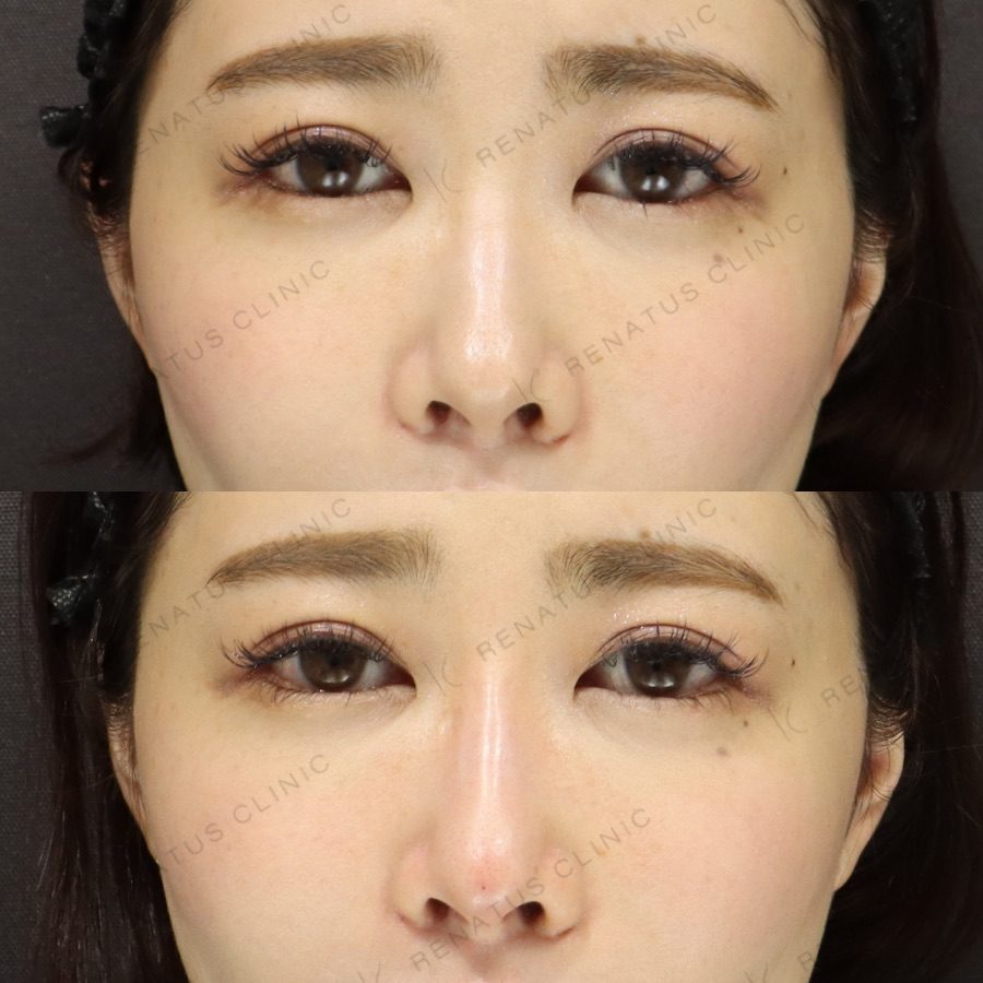 鼻ヒアルロン酸の症例（ボラックス・30代女性）。注入前と注入後の比較
