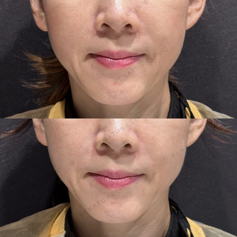 ためしてガッテンのほうれい線の消し方は効く?顔のたるみ改善を美容皮膚科医が解説 32 ほうれい線ヒアルロン酸の症例(ボリフト・40代女性)。注入前と注入後の比較