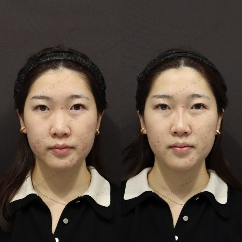 鼻ヒアルロン酸の症例（ボラックス・20代女性）。注入前と注入後の比較